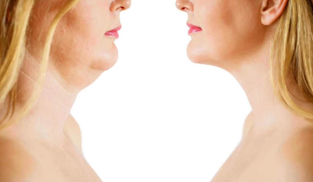 Double Chin treatment Tring before and after results