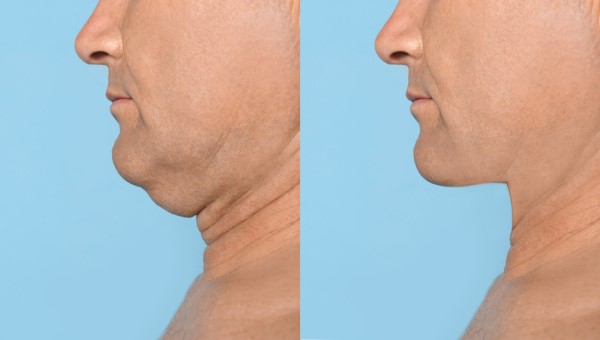 Which Non-Surgical Treatments Work Best for Jowls and Loose Skin Tring?