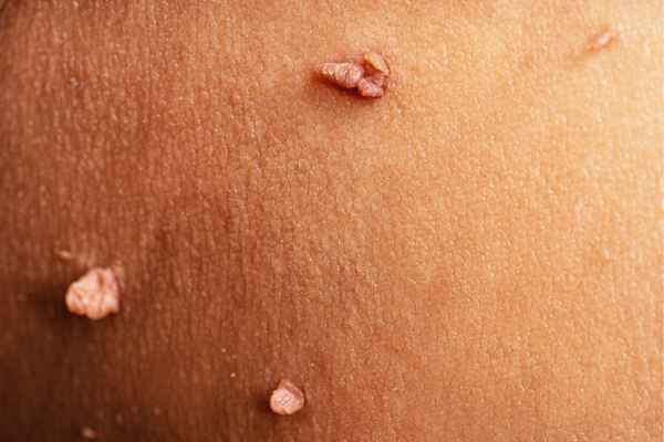 skin tag