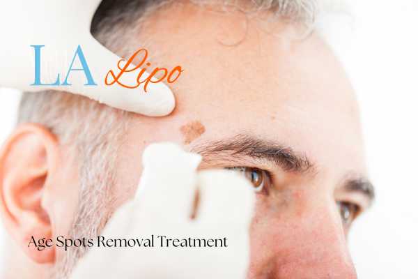 What Are the Most Effective Treatments for Age Spots Tring?