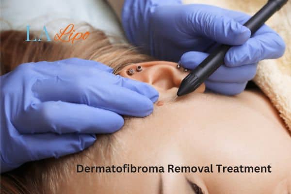 Dermatofibroma Removal Treatment Tring