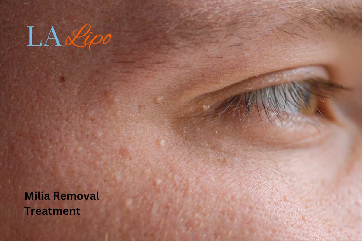 Cryopen Milia Removal: Is It the Easiest and Safest Option Tring?