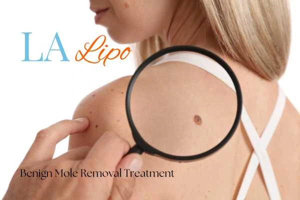 Woman having her inspection of blemish before mole removal Tring