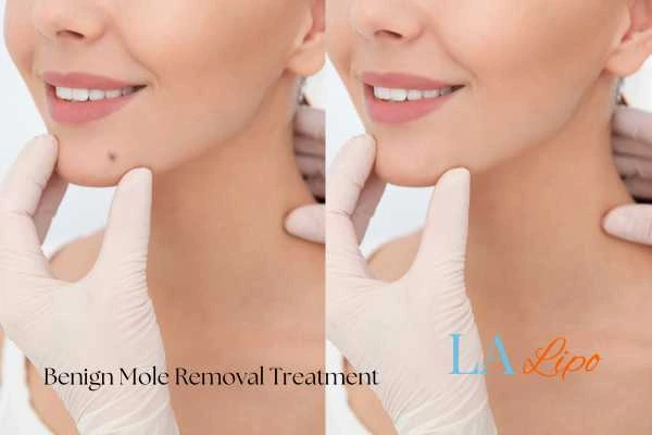 Before and after mole removal Tring treatment