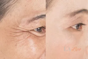 Before and after results of woman - HI-fu wrinkles reduction treatment Tring