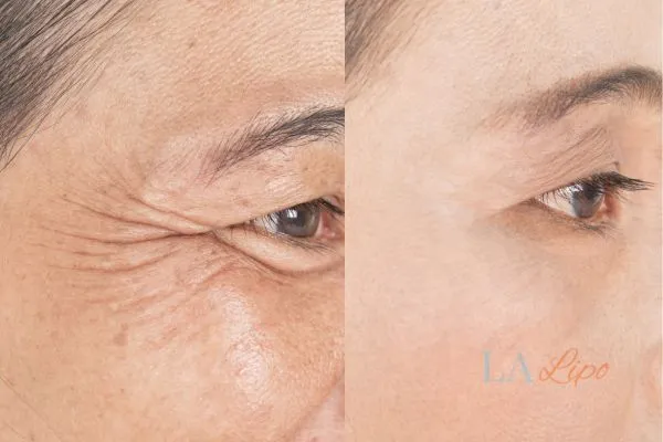Before and after results of woman - HI-fu wrinkles reduction treatment Tring