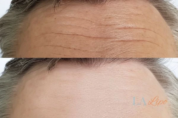 results of HIFU Tring on mans forehead to help reduce lines and wrinkles