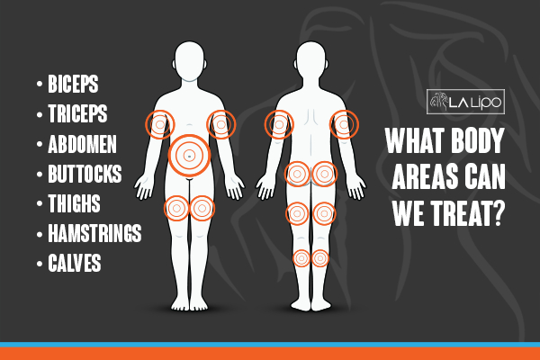 Graphic to show areas you can have LA-EMS Body Sculpting Tring treatment.