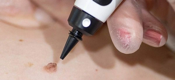skin tag removal using cryopen Tring