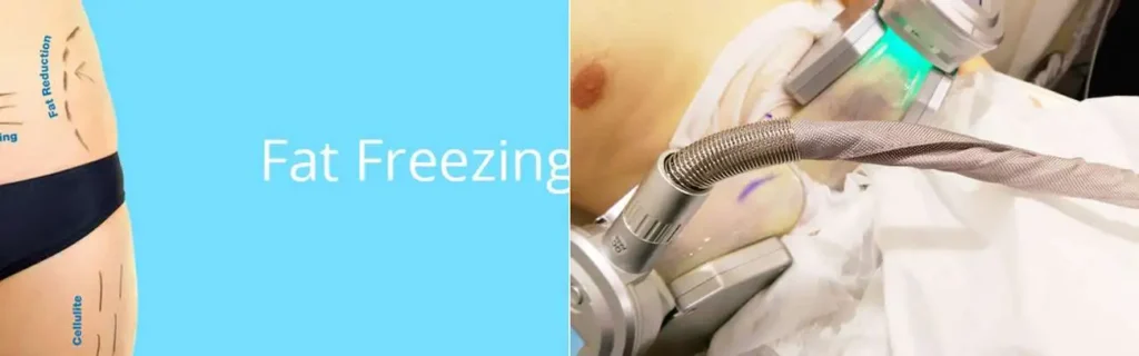 multi areas of a persons body having coolsculpting Tring treatment