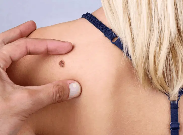 woman having mole removal Tring consultation before treatment.