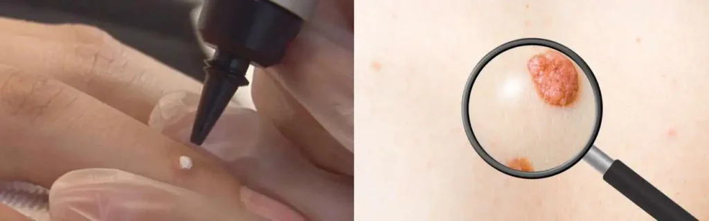 Cryopen for mole removal Tring - speak to our team today!