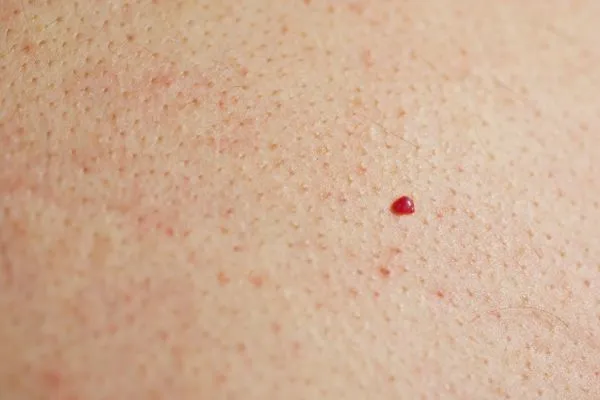 close up of a cherry angioma Tring