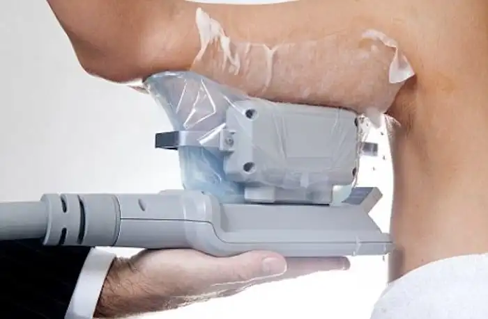 Picture of fat freezing Tring on the upper arms.