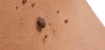 image of a skin tag Tring