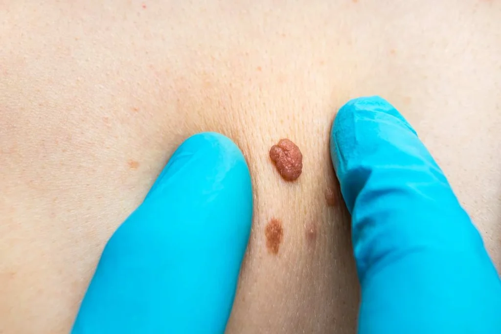 Consultant examining a skin tag Tring