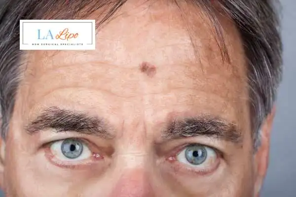Solar Lentigo Removal Tring image of man with mark on his forehead