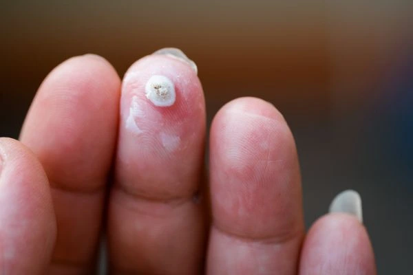 wart on person finger - cryotherapy to treat from LA LIPO Tring