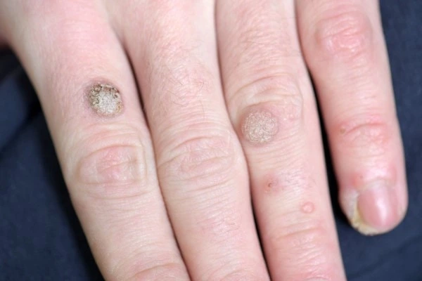photo of warts on person hand - see wart removal Tring from LA LIPO