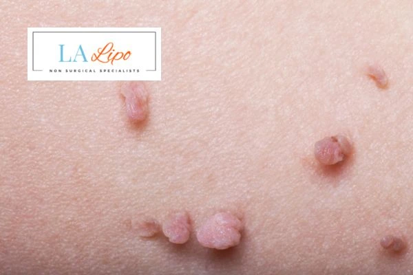 Does cryopen skin tag removal Tring hurt? Find out now call our team today!