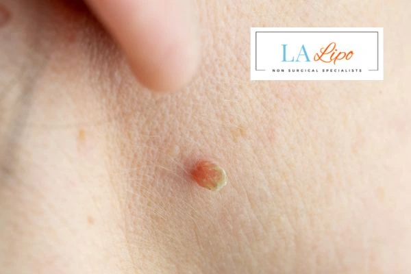 Book skin tag removal Tring today speak to our team now!