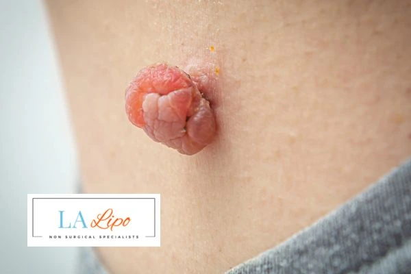 Interested in skin tag removal Tring? Concerned about the pain? Find out more today!