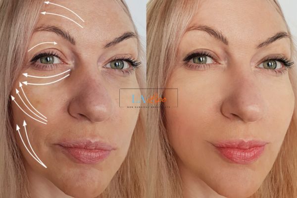 Morpheus 8 results Tring face lift.