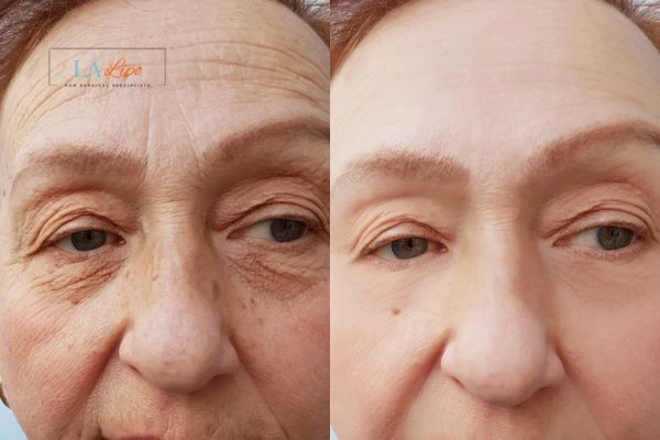 The powerful benefits of Morpheus8 Treatment Tring - Call Our team today!