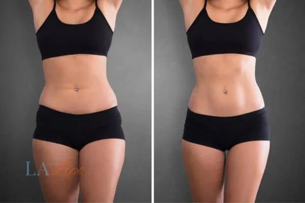 before and after results of non-surgical treatment to help a woman's body image and mental health Tring