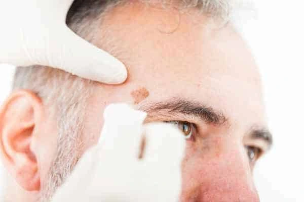 Age spots and elderly people Tring what is the link?