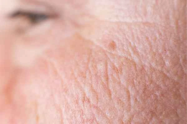 close up picture of a woman's face showing an age spot Tring