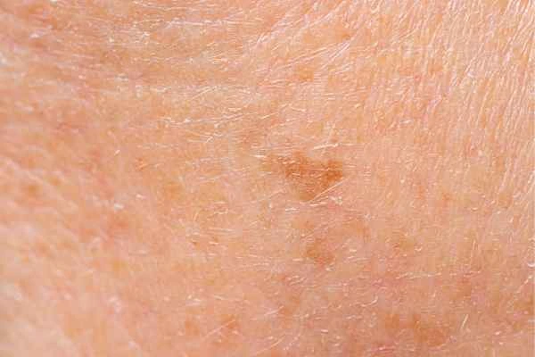 close up picture of age spots Tring