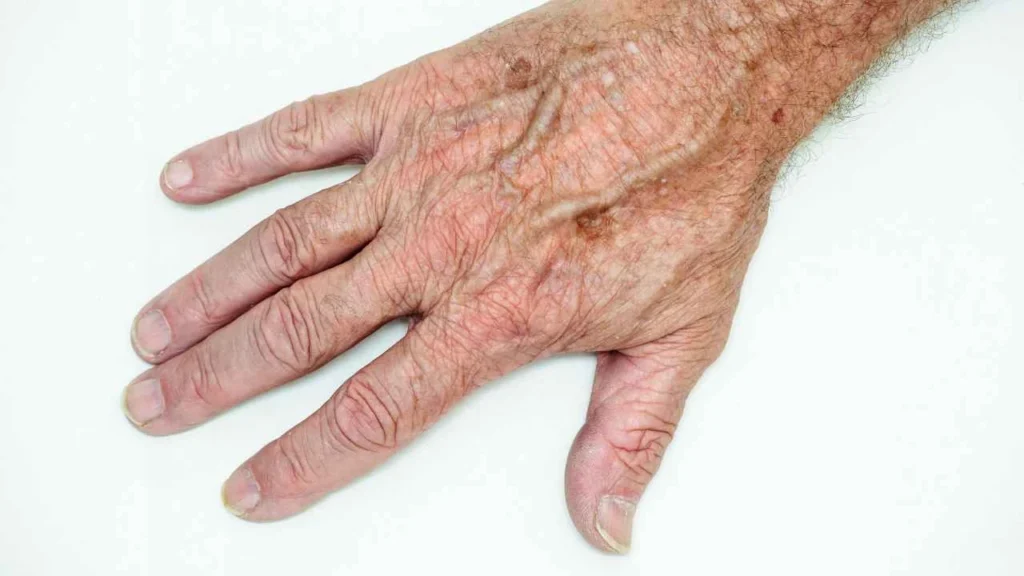 Male hand showing age spot Tring
