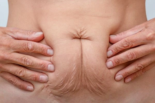 Image of a woman's stomach with loose skin - example of skin tightening Tring options