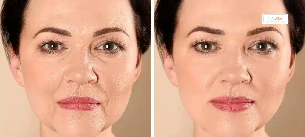 How Long Does It Take to See Results and How Long Do They Last Tring?