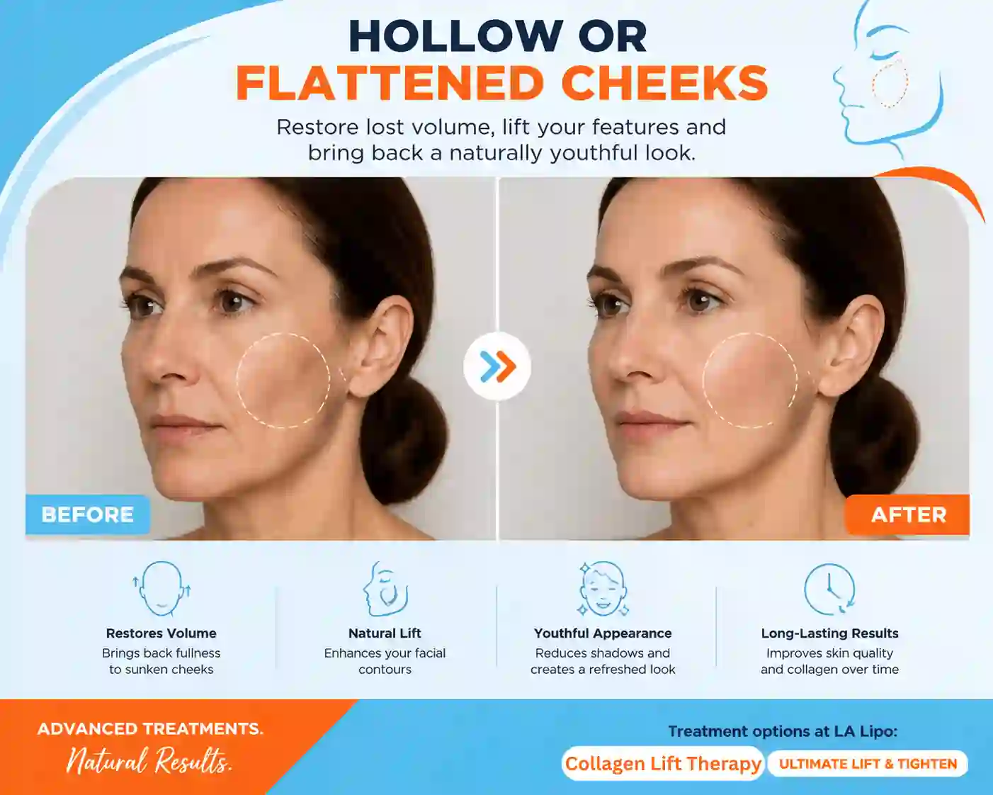 Sign #4: Hollow or Flattened Cheeks Tring