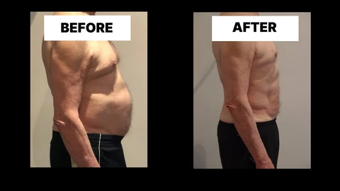 What Symptoms Can Diastasis Recti Cause in Men? Weak Core, Back Pain and Poor Posture Tring